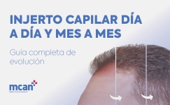 Hair Transplant Timeline es