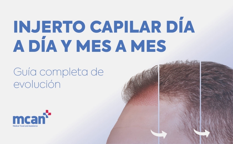Injerto capilar día a día y mes a mes: Guía completa de evolución 3 Hair Transplant Timeline es Hair Transplant Timeline es