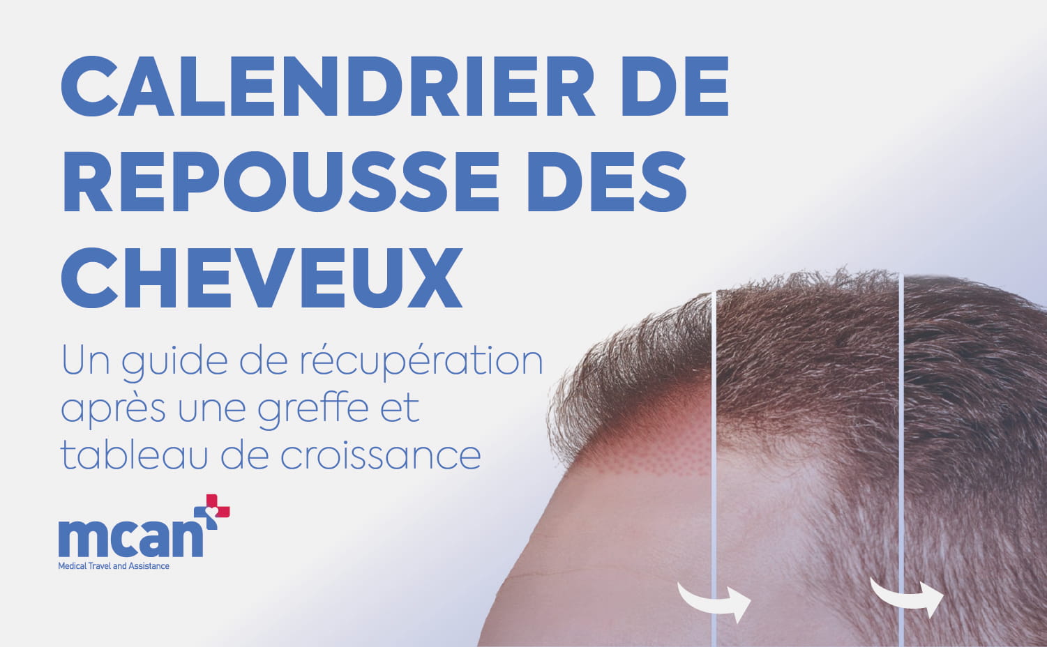 Calendrier de repousse des cheveux : Un guide de récupération après une greffe et tableau de croissance 11 Hair Transplant Timeline fr Hair Transplant Timeline fr