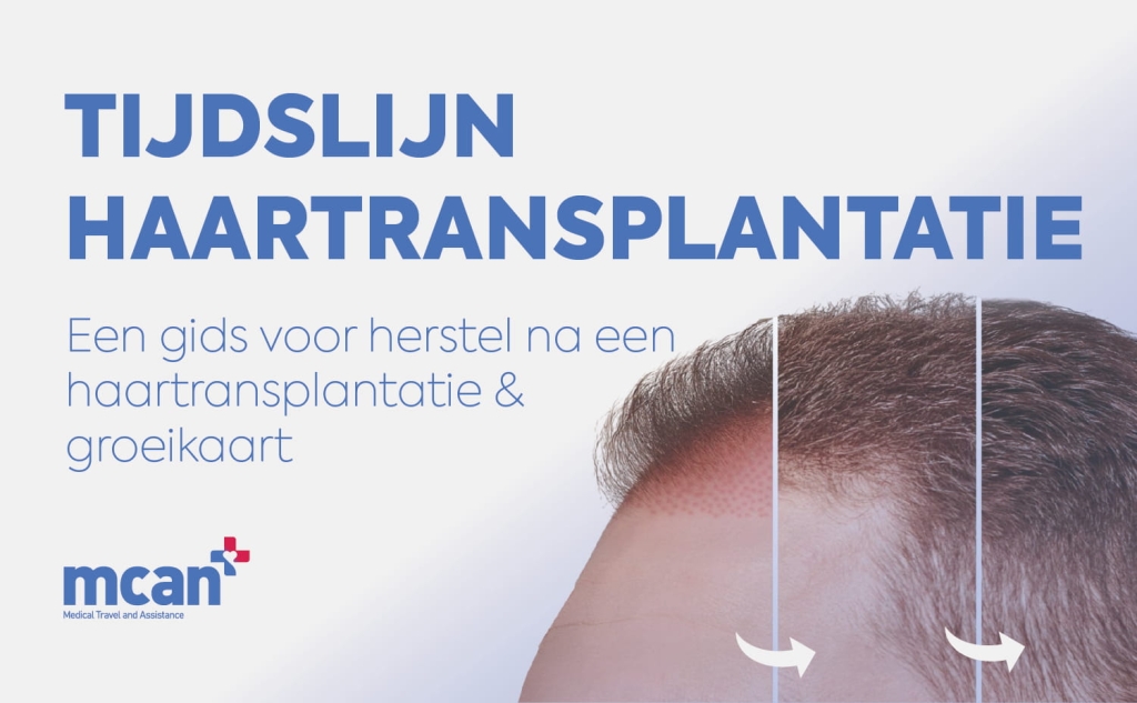 Tijdslijn haartransplantatie: Een gids voor herstel na een haartransplantatie & groeikaart 1 Hair Transplant Timeline nl Hair Transplant Timeline nl