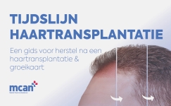 Hair Transplant Timeline nl