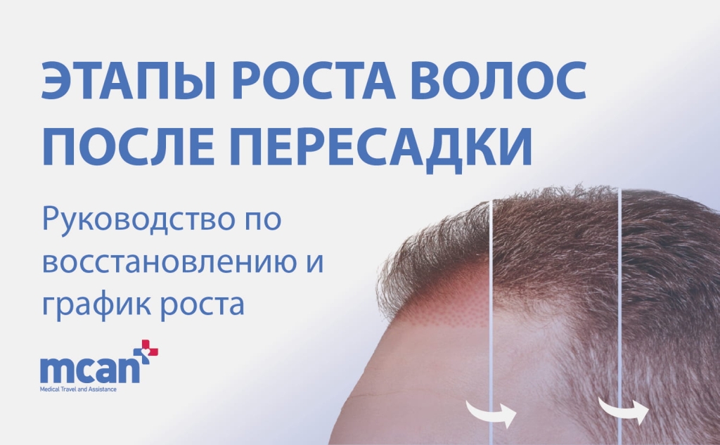 Этапы роста волос после пересадки: Руководство по восстановлению и график роста 1 Hair Transplant Timeline ru Hair Transplant Timeline ru