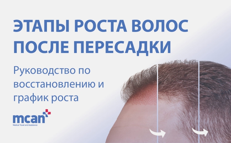 Hair Transplant Timeline ru