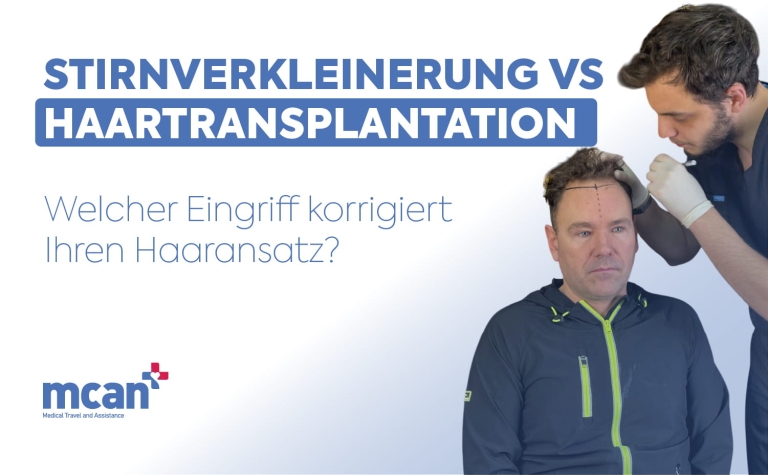 Stirnverkleinerung vs Haartransplantation: Welcher Eingriff korrigiert Ihren Haaransatz? 1 Hairline Lowering Surgery vs Hair Transplant de Hairline Lowering Surgery vs Hair Transplant de