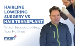 Hairline Lowering Surgery vs Hair Transplant en 1