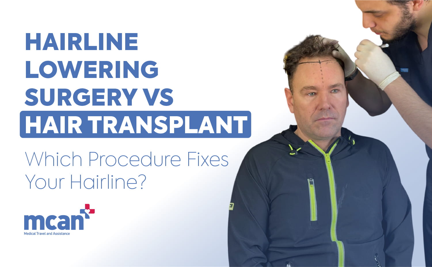 Hairline Lowering Surgery vs Hair Transplant en 1