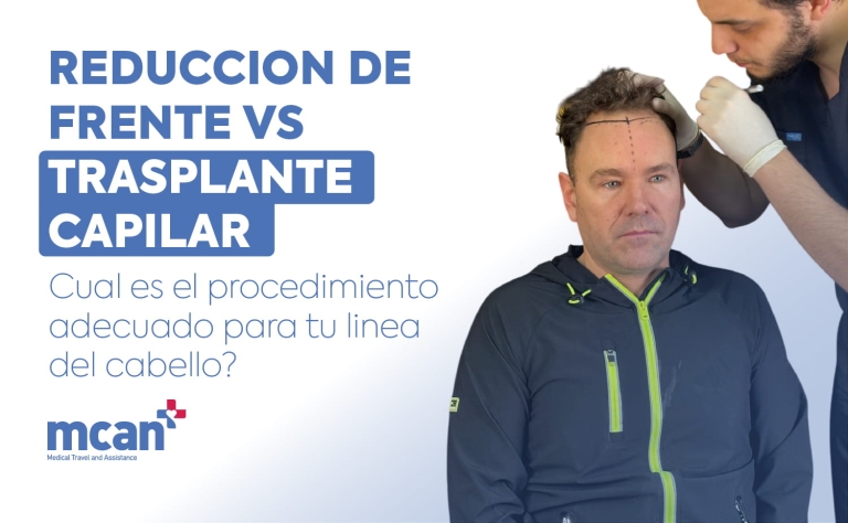 Reduccion de frente vs trasplante capilar: cual es el procedimiento adecuado para tu linea del cabello? 1 Hairline Lowering Surgery vs Hair Transplant es Hairline Lowering Surgery vs Hair Transplant es