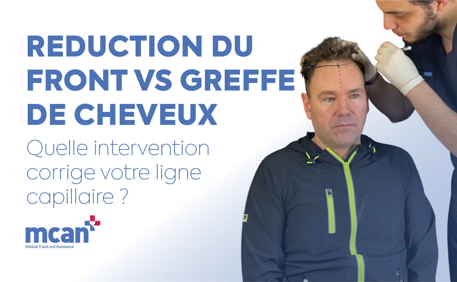 Reduction du front vs greffe de cheveux : quelle intervention corrige votre ligne capillaire ? 9 Hairline Lowering Surgery vs Hair Transplant fr Hairline Lowering Surgery vs Hair Transplant fr