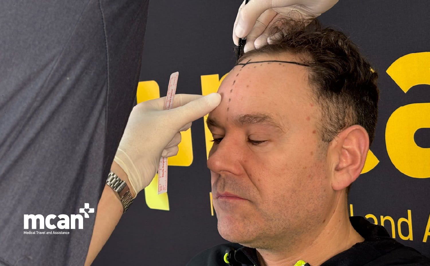 Hairline Lowering Surgery vs Hair Transplant: Which Procedure Fixes Your Hairline? 3 Hairline Lowering vs Hair Transplant Hairline Lowering vs Hair Transplant
