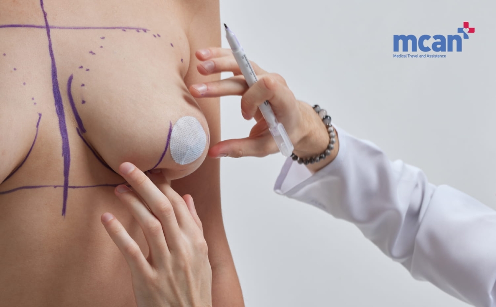 Hybrid Breast Augmentation: Combining Implants with Fat Transfer for Natural, Long-Lasting Results 3 How Does Hybrid Breast Augmentation Work How Does Hybrid Breast Augmentation Work