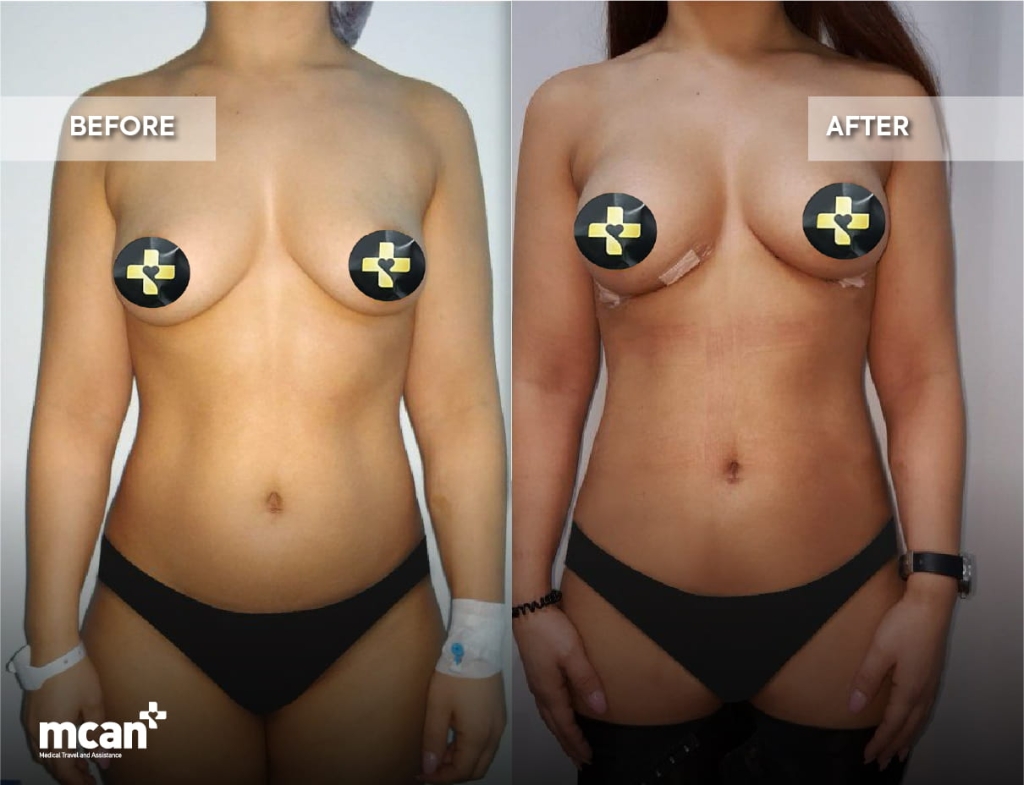 Hybrid Breast Augmentation: Combining Implants with Fat Transfer for Natural, Long-Lasting Results 4 Hybrid Breast Augmentation in Turkey with MCAN Health Hybrid Breast Augmentation in Turkey with MCAN Health
