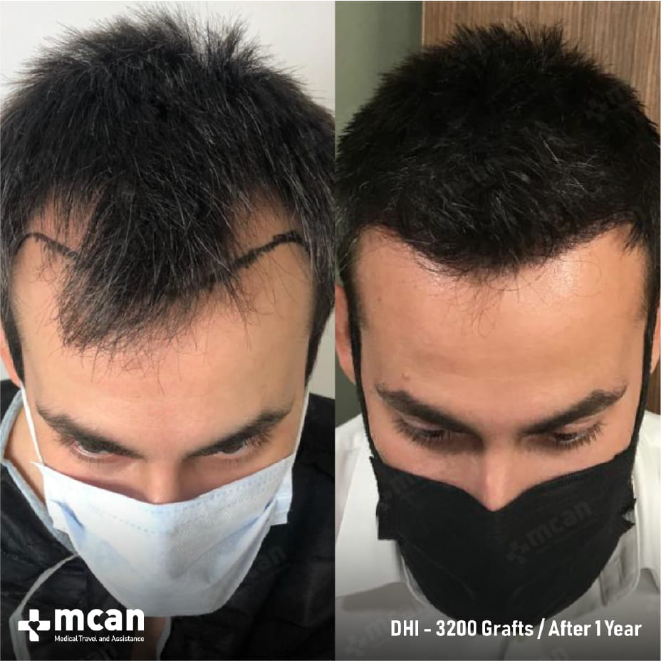 M-Shaped Hairline: Causes and Hair Transplant Solutions 5 M Shaped Hairline Treatment in Turkey with MCAN Health M Shaped Hairline Treatment in Turkey with MCAN Health