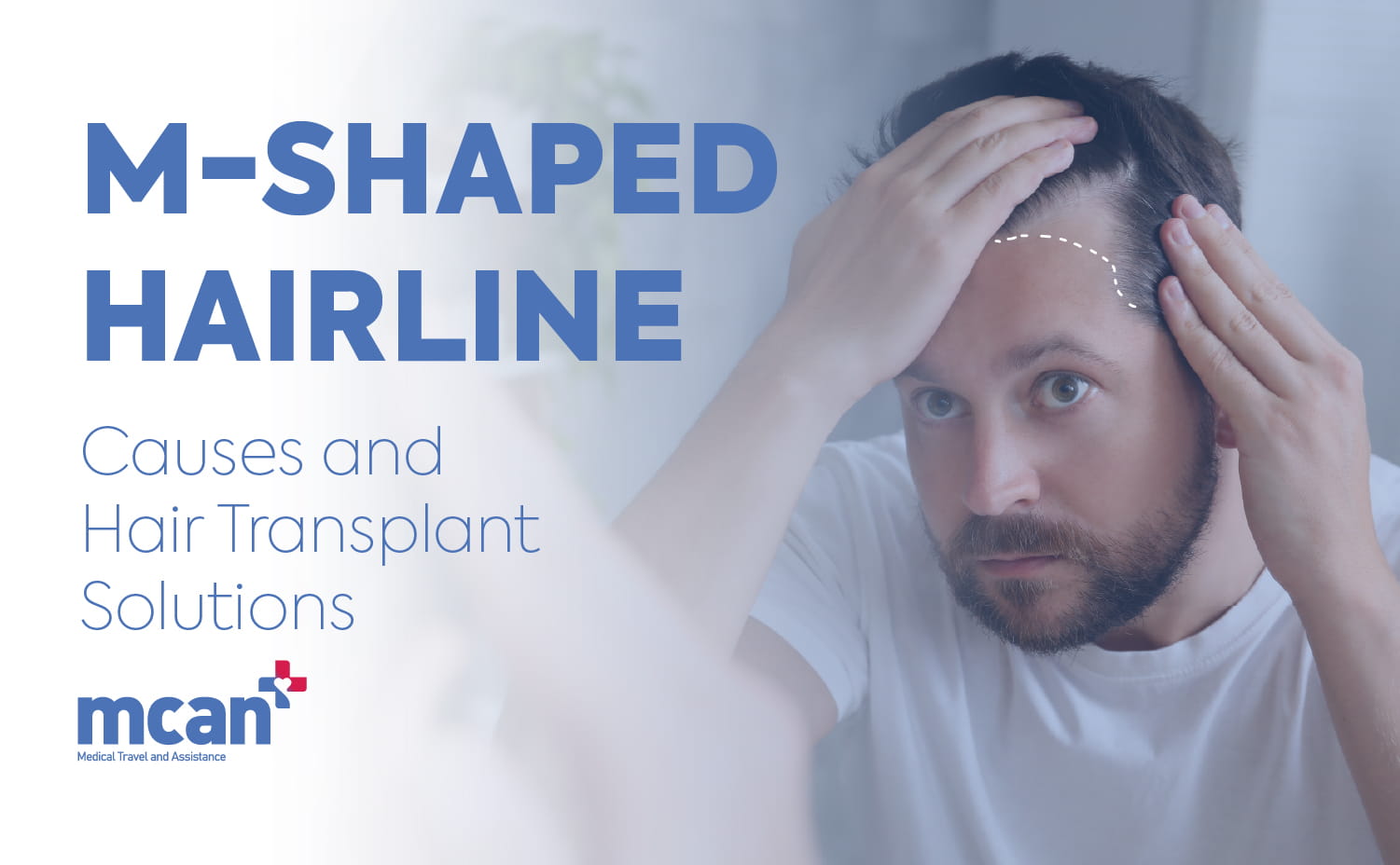 M Shaped Hairline en