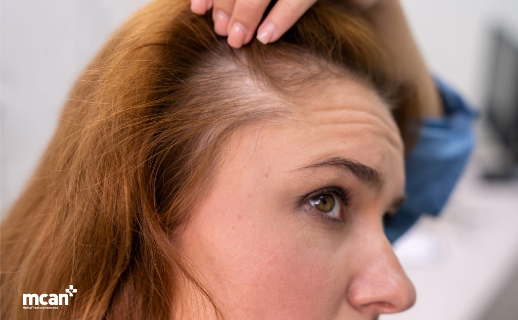 M-Shaped Hairline: Causes and Hair Transplant Solutions 3 M Shaped Hairline in Women M Shaped Hairline in Women
