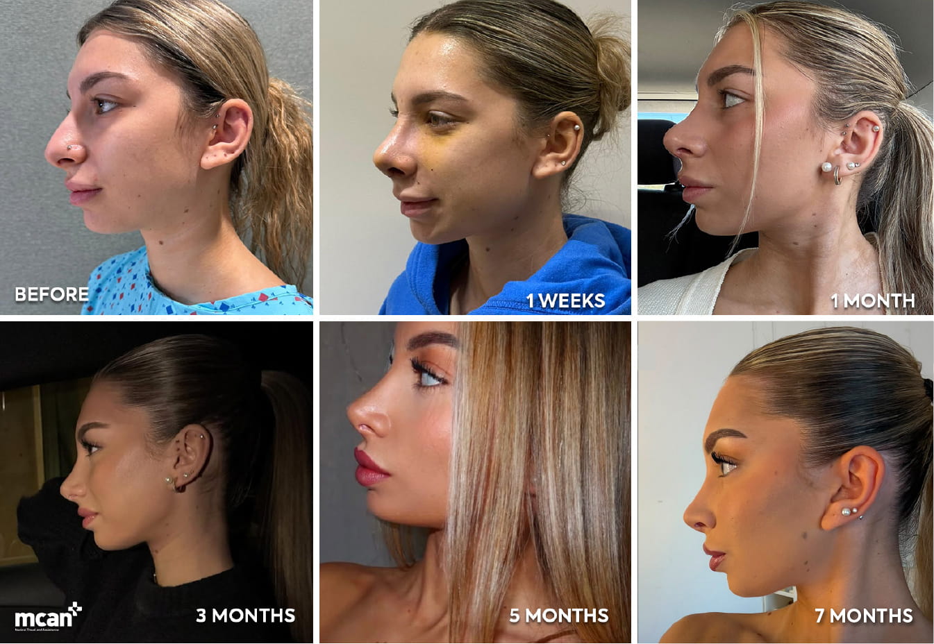 Male vs Female Rhinoplasty: How Gender Shapes Your Nose Job 5 Male vs Female Rhinoplasty Recovery and Results en Male vs Female Rhinoplasty Recovery and Results en