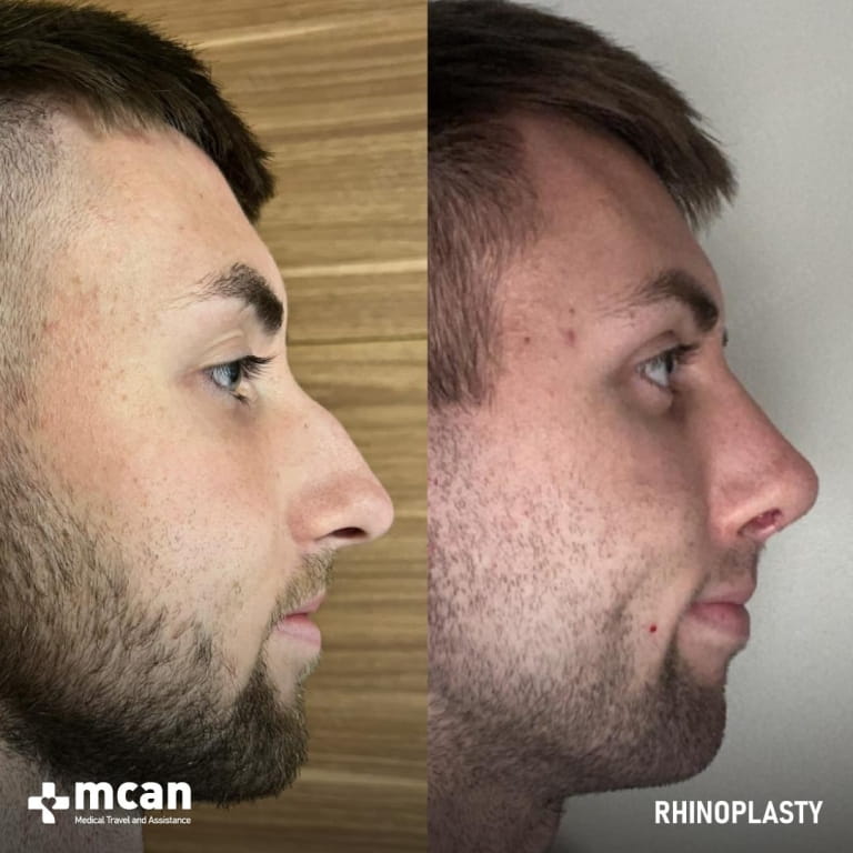 Male vs Female Rhinoplasty: How Gender Shapes Your Nose Job 3 Rhinoplasty Nose Job Before After 35 768x768 1 Rhinoplasty Nose Job Before After 35 768x768 1