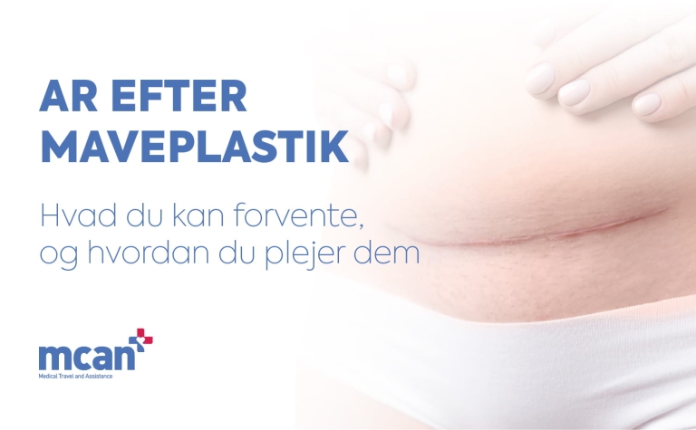 Ar efter maveplastik: Hvad kan du forvente, og hvordan plejer du dem? 9 Tummy Tuck Scars da Tummy Tuck Scars da