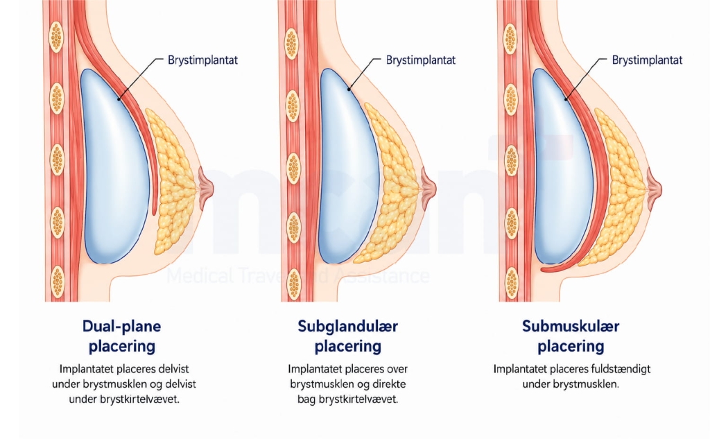 Brystforstørrelse Dual Plane: Hvorfor placering er vigtig 2 What Is Dual Plane Breast Augmentation da 1 What Is Dual Plane Breast Augmentation da 1