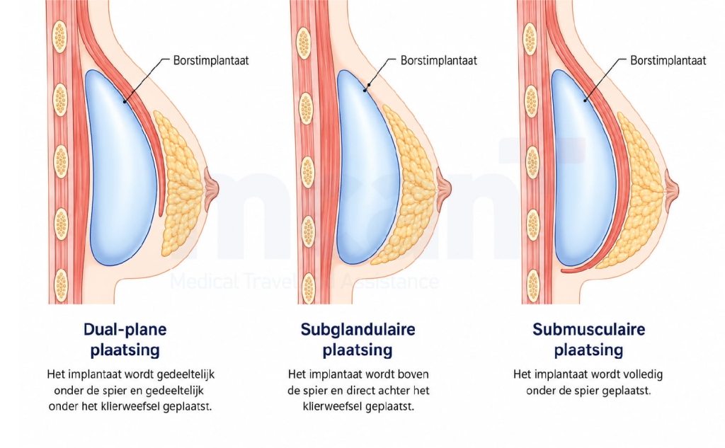 Borstvergroting Dual Plane: Waarom plaatsing belangrijk is 2 What Is Dual Plane Breast Augmentation nl 1 What Is Dual Plane Breast Augmentation nl 1