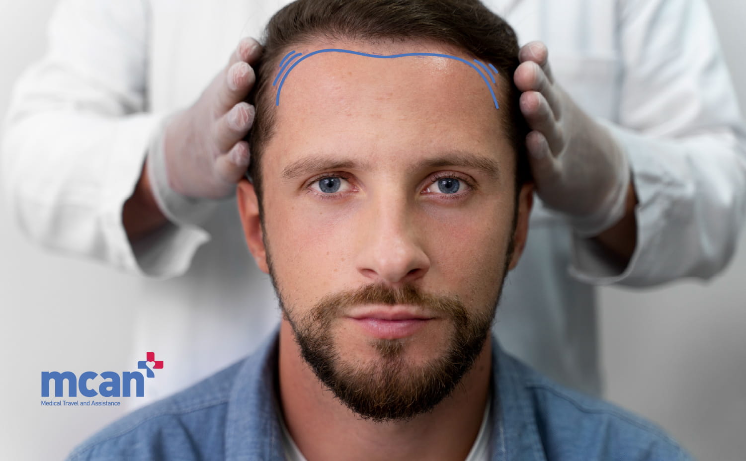 Hairline Lowering Surgery vs Hair Transplant: Which Procedure Fixes Your Hairline? 2 What Is Hairline Lowering Surgery and How Does It Work What Is Hairline Lowering Surgery and How Does It Work