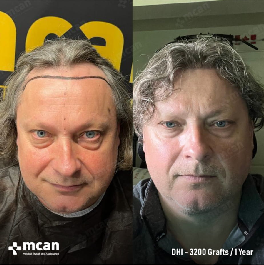 Hairline Lowering Surgery vs Hair Transplant: Which Procedure Fixes Your Hairline? 5 ba ba