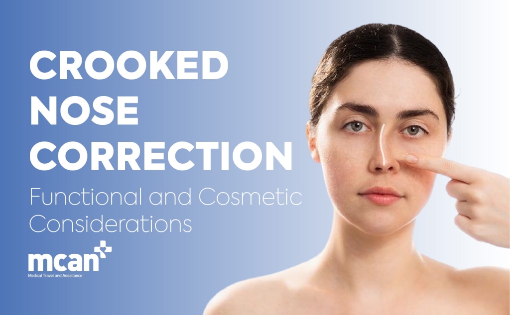 Crooked Nose Correction: Functional and Cosmetic Considerations 1 Crooked Nose Correction EN Crooked Nose Correction EN