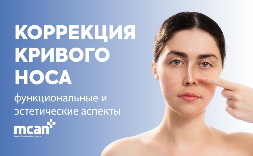 Коррекция кривого носа: функциональные и эстетические аспекты 1 Crooked Nose Correction RU Crooked Nose Correction RU