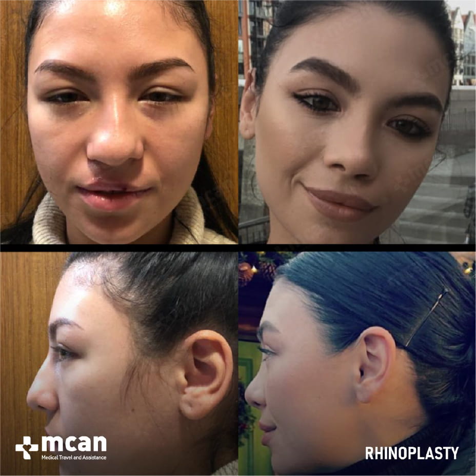 Коррекция кривого носа: функциональные и эстетические аспекты 6 Crooked Nose Correction in Turkey with MCAN Health 4 Crooked Nose Correction in Turkey with MCAN Health 4