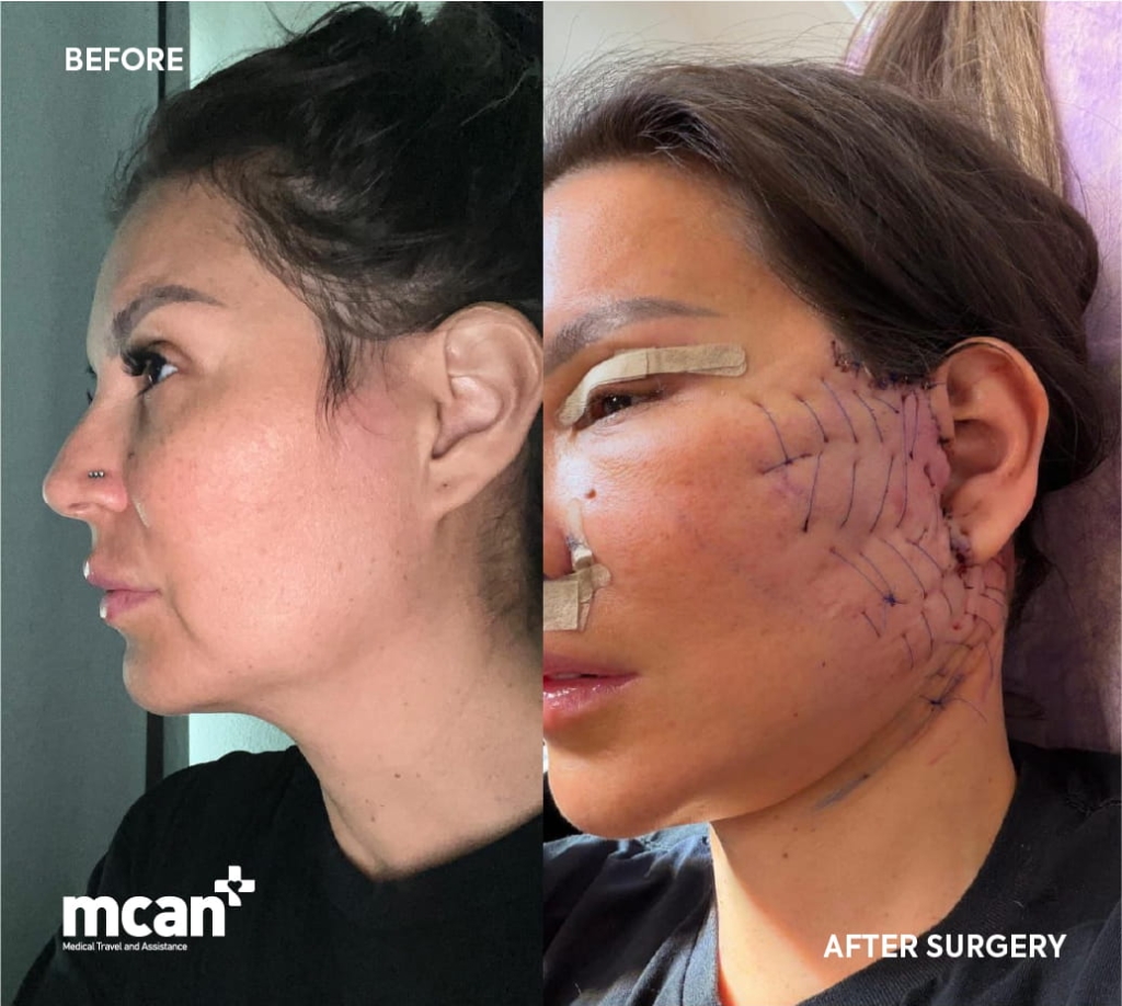 ¿Qué es la técnica Spider Web (red hemostática) en el lifting facial? 5 Facelift Surgery with the Spider Web Technique at MCAN Health 1 1 1 Facelift Surgery with the Spider Web Technique at MCAN Health 1 1 1