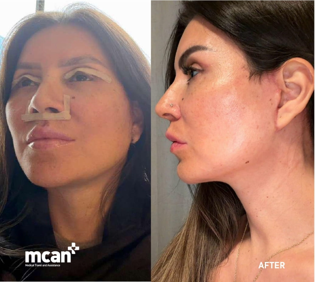 ¿Qué es la técnica Spider Web (red hemostática) en el lifting facial? 6 Facelift Surgery with the Spider Web Technique at MCAN Health 2 1 1 Facelift Surgery with the Spider Web Technique at MCAN Health 2 1 1
