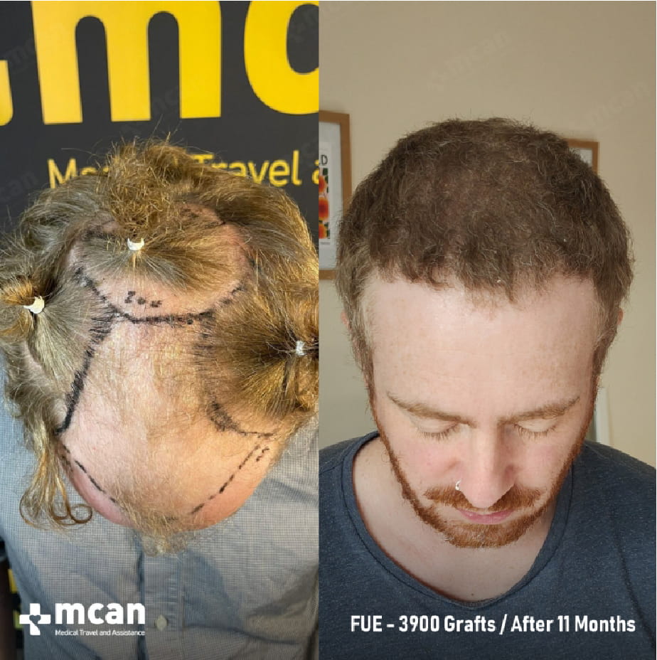 Retrograde Alopecia and the Donor Area: What It Means for Your Hair Transplant Assessment 4 Hair Transplant Planning in Turkey with MCAN Health Hair Transplant Planning in Turkey with MCAN Health