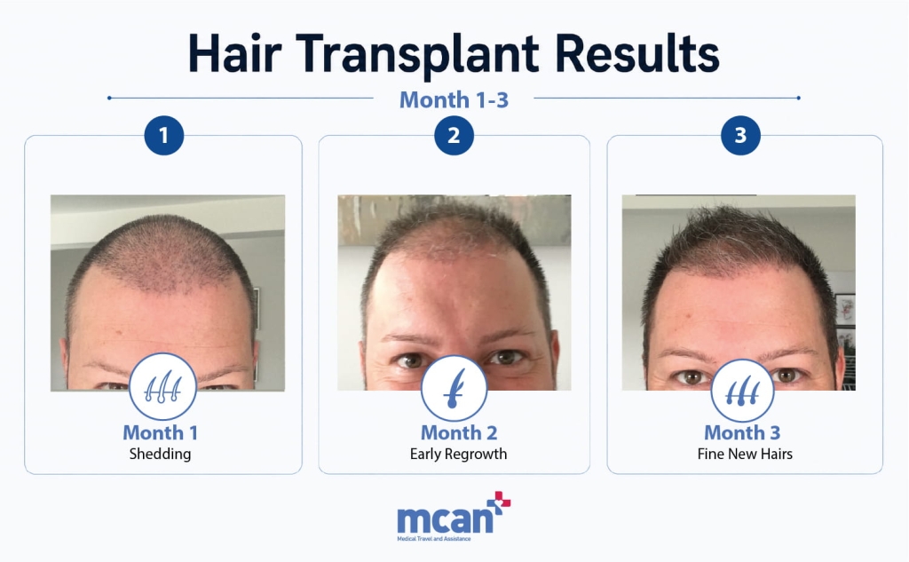 Hair Transplant Results: Why They Look Different at 3, 6, and 12 Months 2 Hair Transplant Results at 1 to 3 Months en 1 Hair Transplant Results at 1 to 3 Months en 1