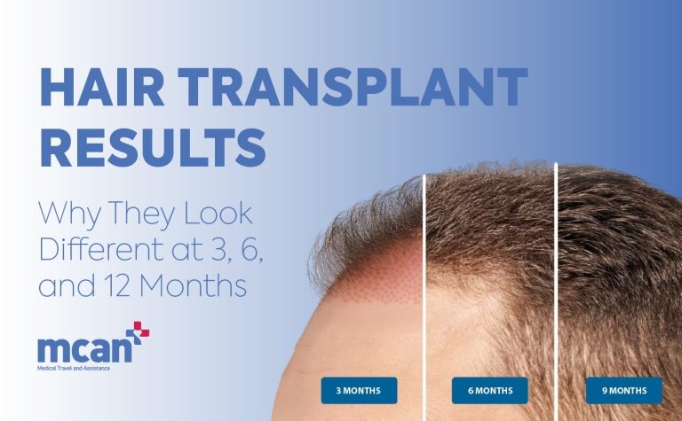 Hair Transplant Results: Why They Look Different at 3, 6, and 12 Months