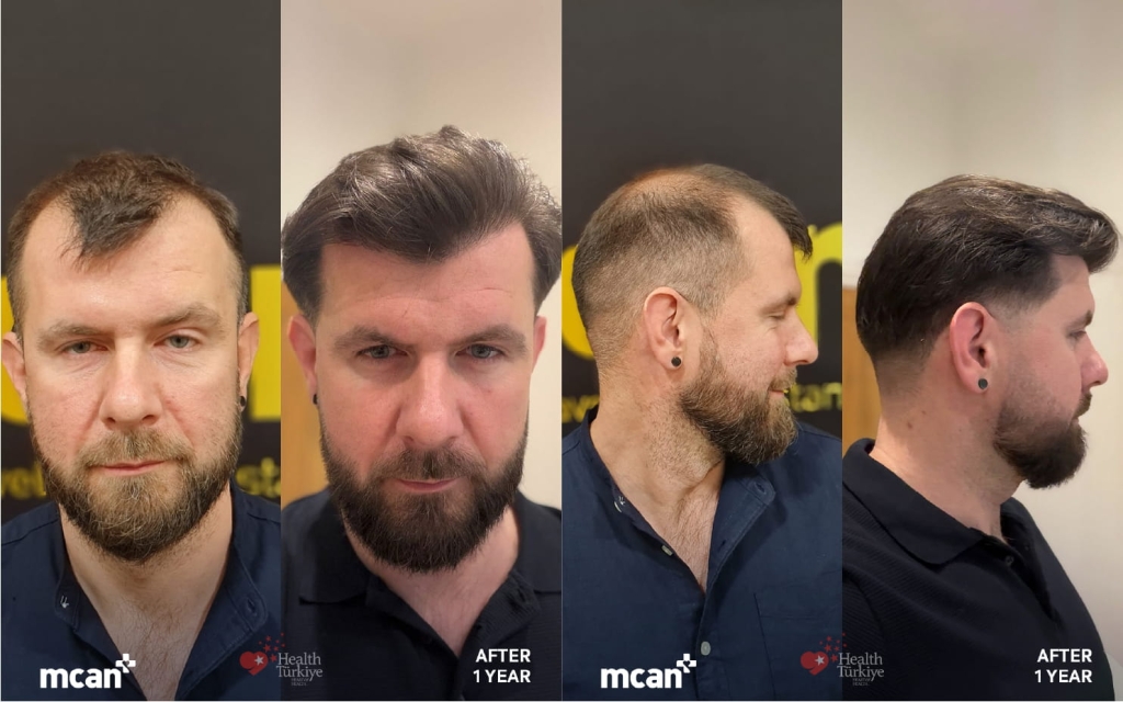 Hair Transplant Results: Why They Look Different at 3, 6, and 12 Months 4 Hair Transplant Results in Turkey with MCAN Health Hair Transplant Results in Turkey with MCAN Health