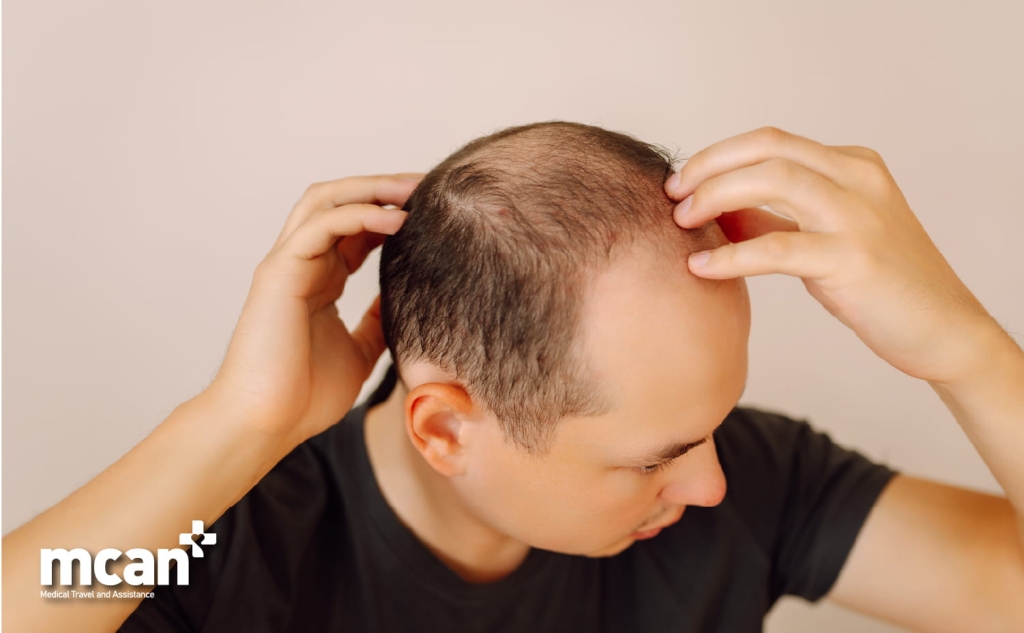 Retrograde Alopecia and the Donor Area: What It Means for Your Hair Transplant Assessment 3 Is Retrograde Alopecia Treatable or Does It Get Worse Over Time Is Retrograde Alopecia Treatable or Does It Get Worse Over Time