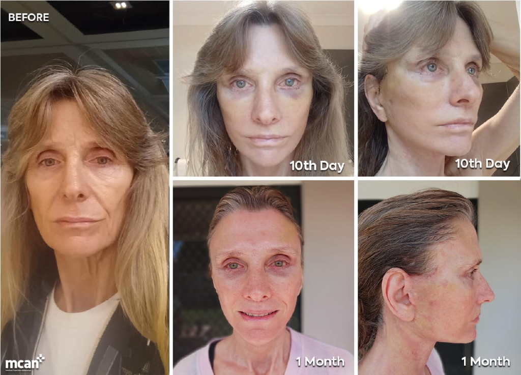 Fat Grafting in Facial Surgery: How Much Fat Is Taken and Where From? 4 Recovery After a Combined Facelift and Fat Transfer en Recovery After a Combined Facelift and Fat Transfer en