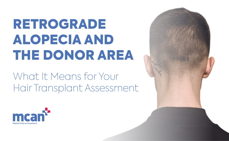Retrograde Alopecia and the Donor Area: What It Means for Your Hair Transplant Assessment