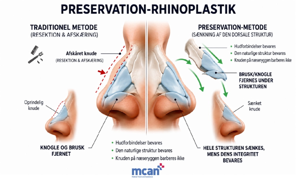What Is Preservation Rhinoplasty da