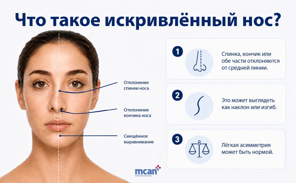 Коррекция кривого носа: функциональные и эстетические аспекты 2 What Is a Crooked Nose RU What Is a Crooked Nose RU