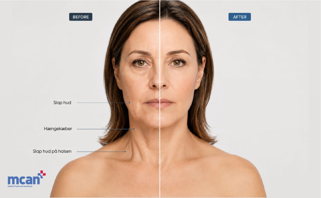 Hvad er spider web-teknikken (hæmostatisk net) ved et facelift? 3 Who Needs the Spider Web Technique During Facelift Surgery da Who Needs the Spider Web Technique During Facelift Surgery da