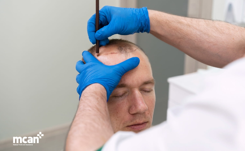 Hair Transplant Results: Why They Look Different at 3, 6, and 12 Months 3 Why Before and After Hair Transplant Photos Can Be Misleading Why Before and After Hair Transplant Photos Can Be Misleading