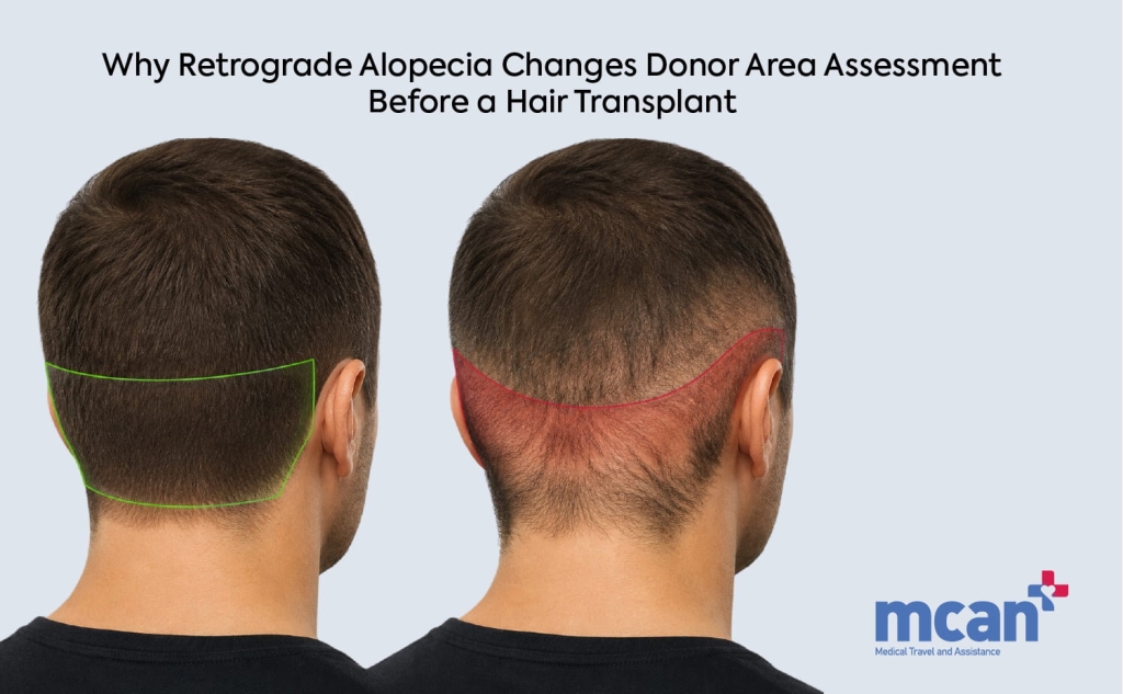 Retrograde Alopecia and the Donor Area: What It Means for Your Hair Transplant Assessment 2 Why Retrograde Alopecia Changes Donor Area Assessment Before a Hair Transplant en Why Retrograde Alopecia Changes Donor Area Assessment Before a Hair Transplant en