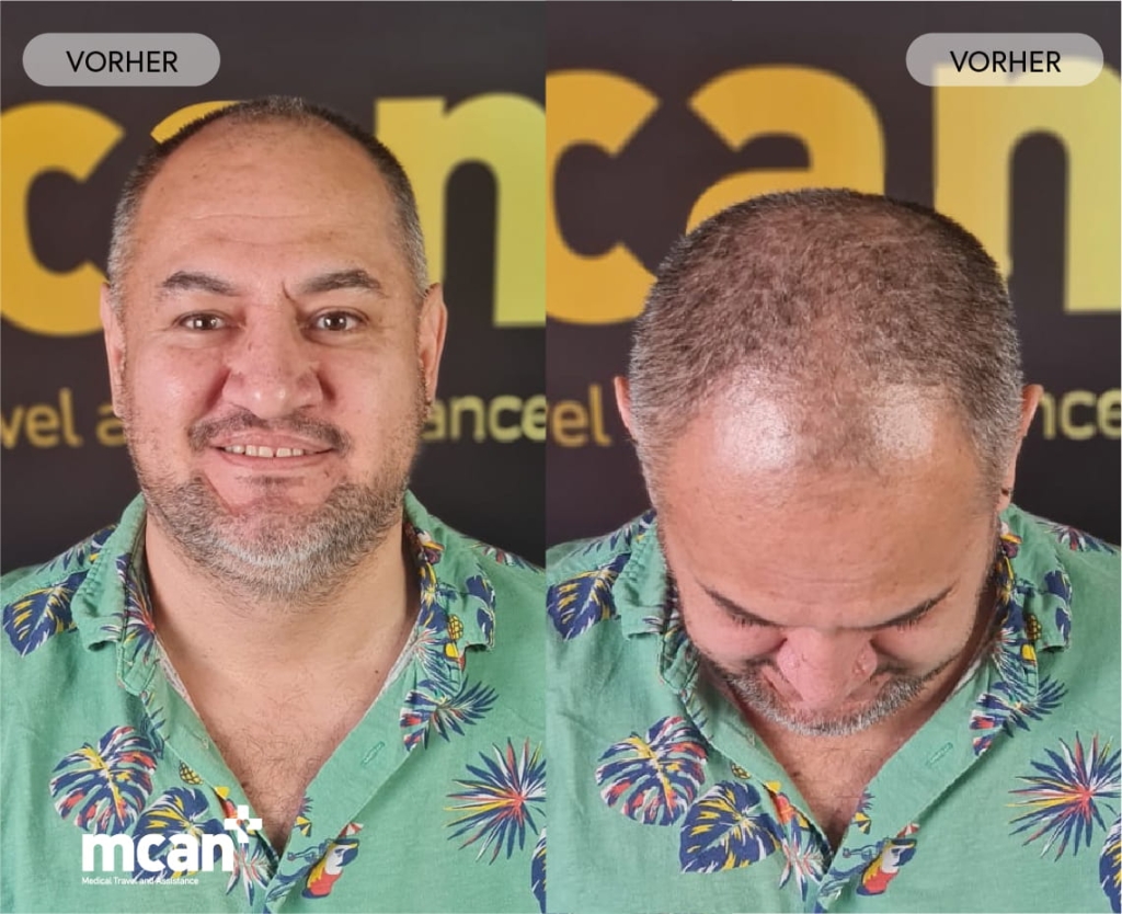 Brauchen Sie eine zweite Haartransplantation? Kann eine zweite Prozedur die Dichte erhöhen? 2 1 How Long to Wait and How to Know You re Ready de 1 How Long to Wait and How to Know You re Ready de