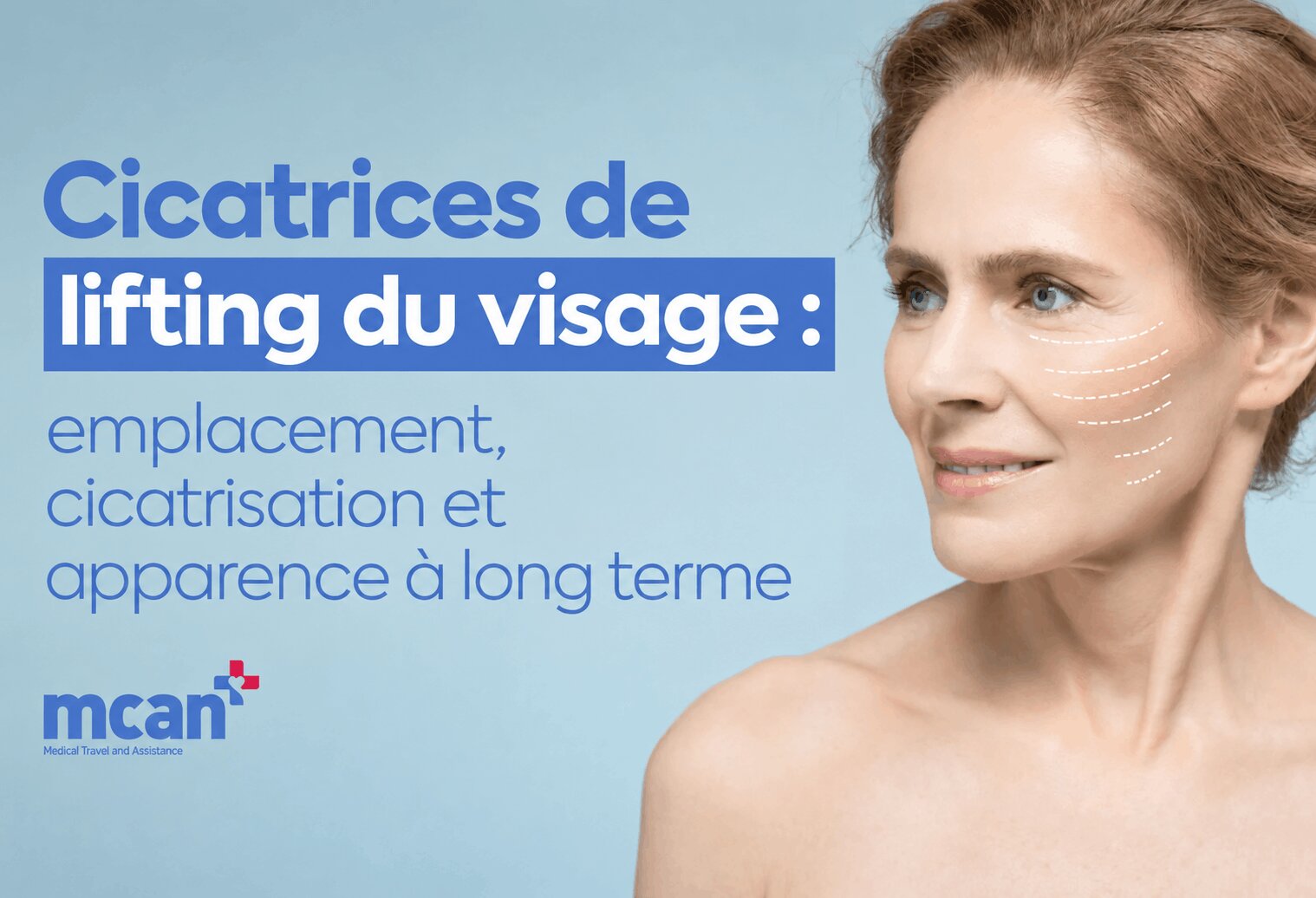 Cicatrices de lifting du visage : emplacement, cicatrisation et apparence à long terme 1 374f1535 Cicatrices de lifting du visage : emplacement, cicatrisation et apparence à long terme