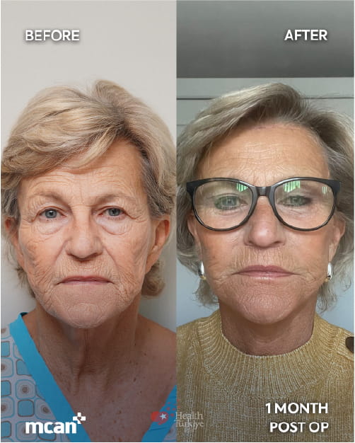 Lidstraffung vs. Stirnlift: Welcher Eingriff hilft bei hängenden, schweren Augen? 5 Blepharoplasty and Brow Lift in Turkey with MCAN Health 1 1 Blepharoplasty and Brow Lift in Turkey with MCAN Health 1 1