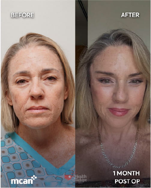 Lidstraffung vs. Stirnlift: Welcher Eingriff hilft bei hängenden, schweren Augen? 6 Blepharoplasty and Brow Lift in Turkey with MCAN Health 2 1 Blepharoplasty and Brow Lift in Turkey with MCAN Health 2 1