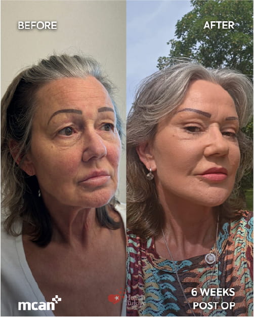 Lidstraffung vs. Stirnlift: Welcher Eingriff hilft bei hängenden, schweren Augen? 7 Blepharoplasty and Brow Lift in Turkey with MCAN Health 3 1 Blepharoplasty and Brow Lift in Turkey with MCAN Health 3 1