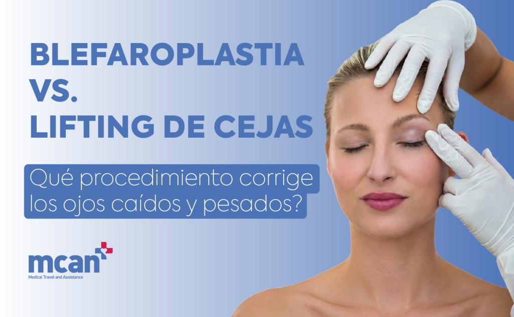 Blefaroplastia vs. Lifting de Cejas: ¿qué procedimiento corrige los ojos caídos y pesados? 1 Blepharoplasty vs. Brow Lift ES 1 Blepharoplasty vs. Brow Lift ES 1