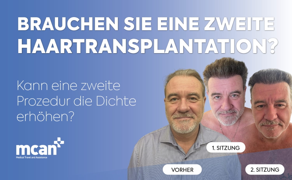Brauchen Sie eine zweite Haartransplantation? Kann eine zweite Prozedur die Dichte erhöhen? 1 Do You Need a Second Hair Transplant de 1 Do You Need a Second Hair Transplant de 1