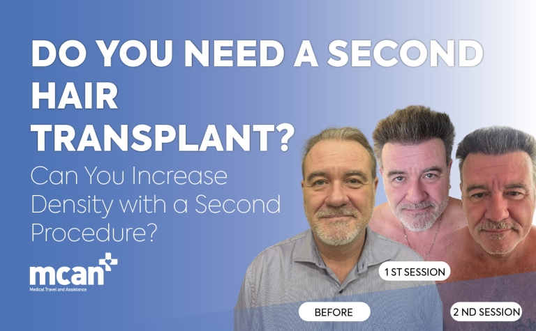 Do You Need a Second Hair Transplant? Can You Increase Density with a Second Procedure?